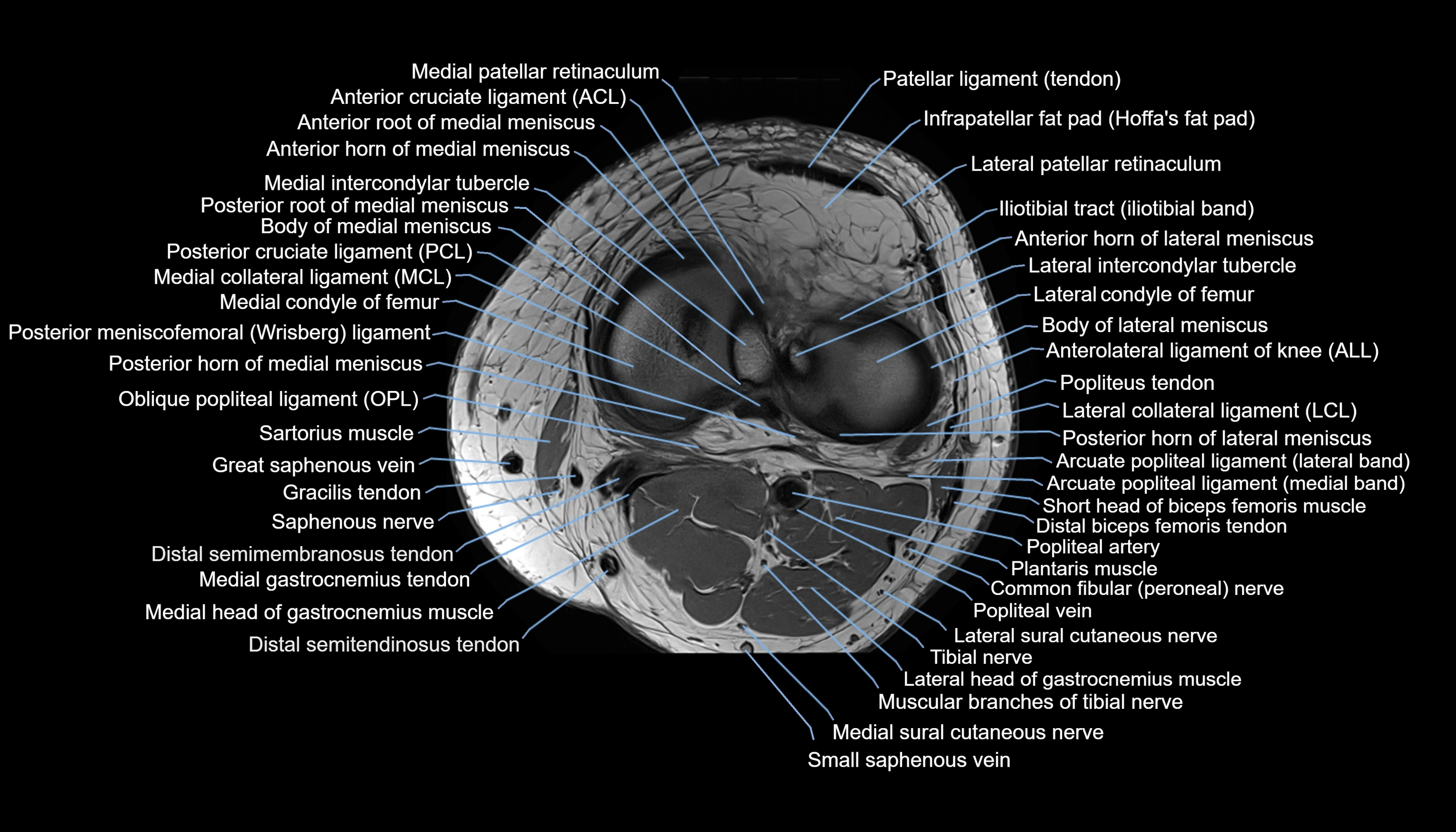 MRI knee  axial cross sectional anatomy 3T radiology  image-img-00001-00029.webp